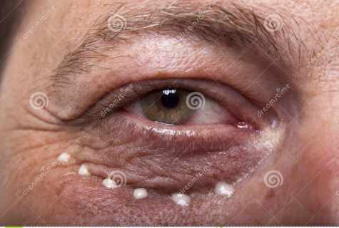Oil from wrinkles under eyes