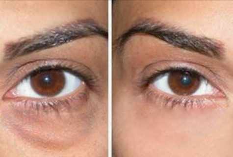 How to remove reddenings under eyes?