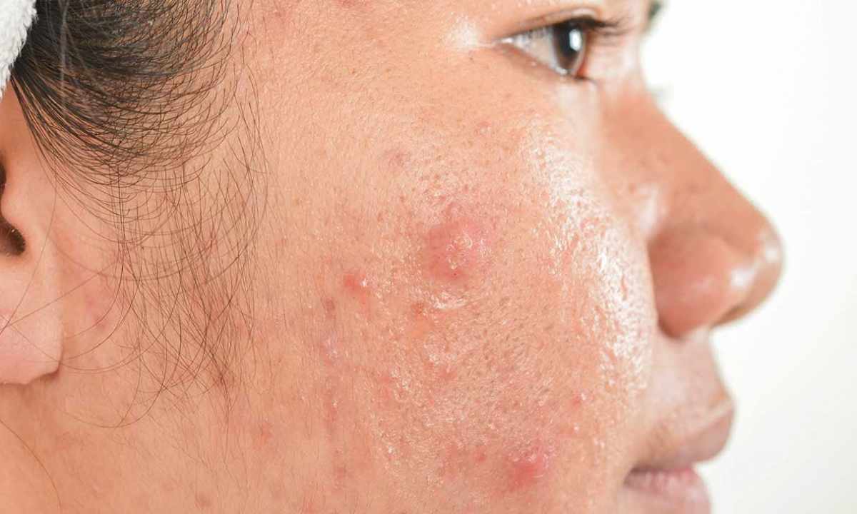 How quickly to remove red pimple