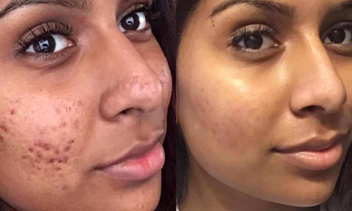 Pimples on the face: reasons, treatment and prevention