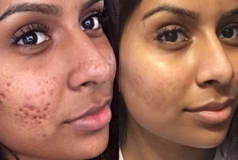 Pimples on the face: reasons, treatment and prevention