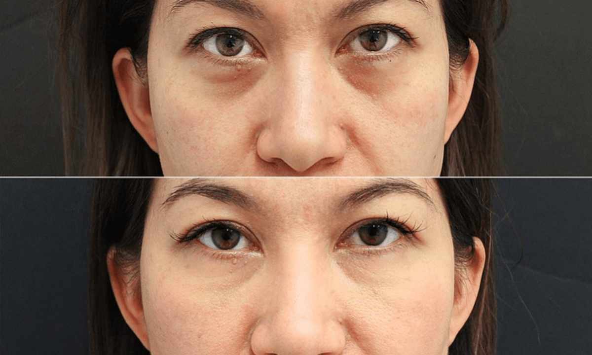 How independently to remove bags under eyes