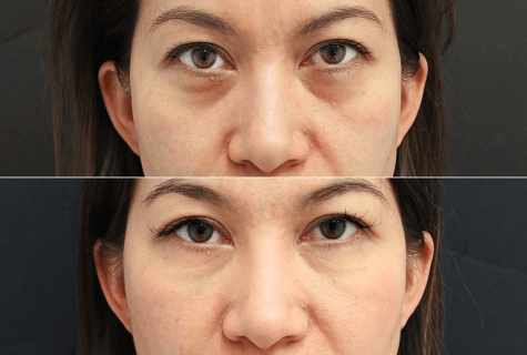 How independently to remove bags under eyes