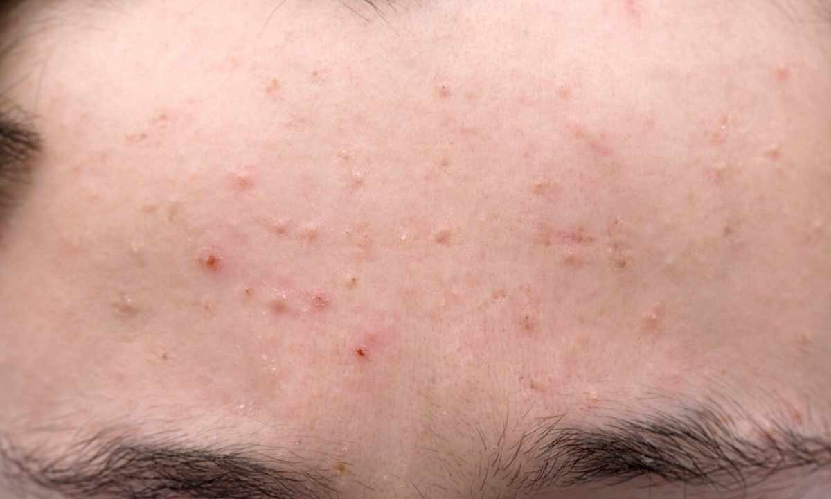 How to remove red heat-spots