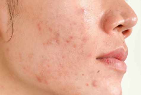 How to remove red traces from pimples
