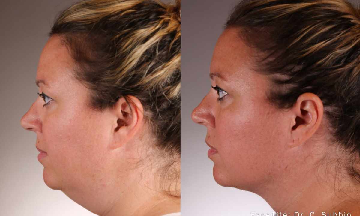 What is non-invasive face lifting