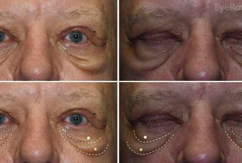 What to do with upper eyelid spot