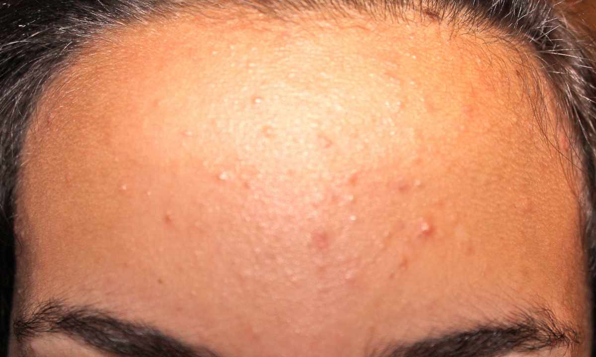 How to treat acne rash on face