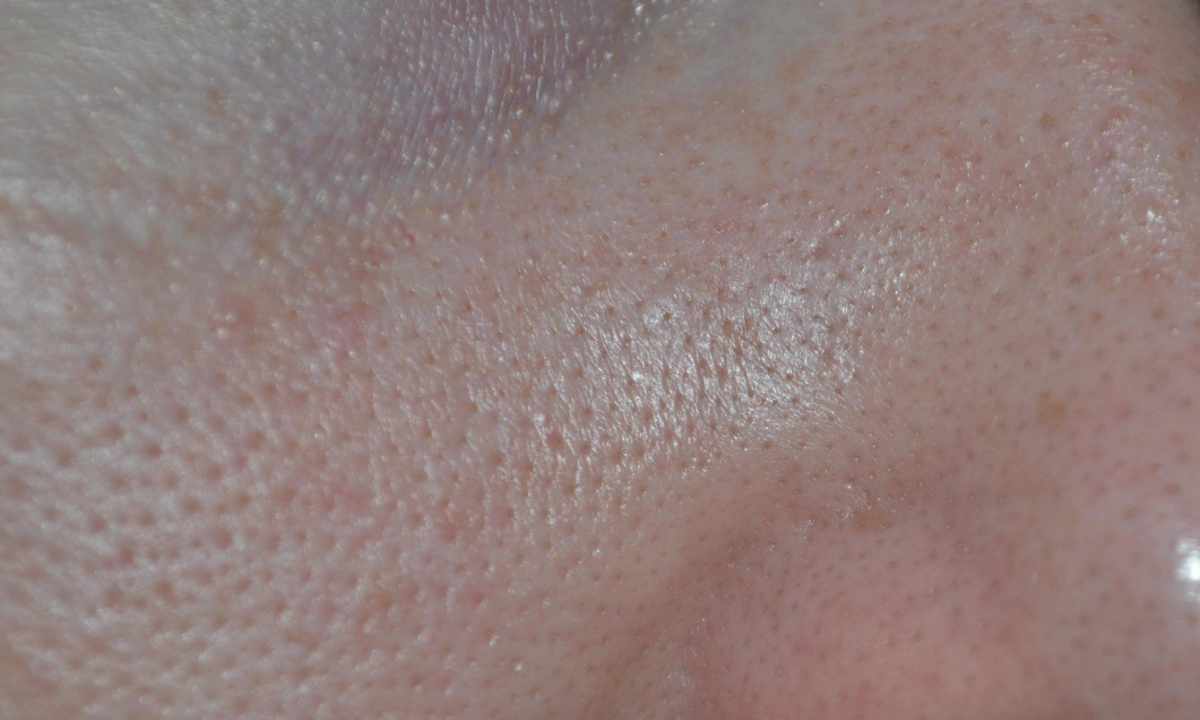 How to clean the hammered skin pores of the person