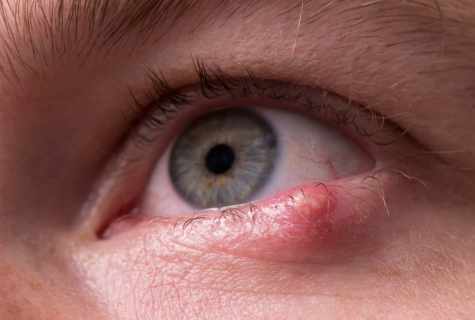 Fatty tumors under eyes: reasons, fight methods