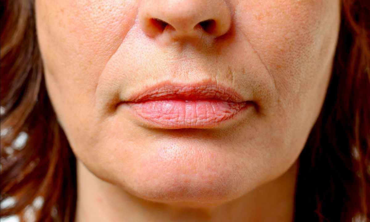How to get rid of wrinkles over lips