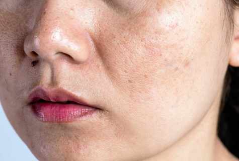 Dry spots on face: what should I do?