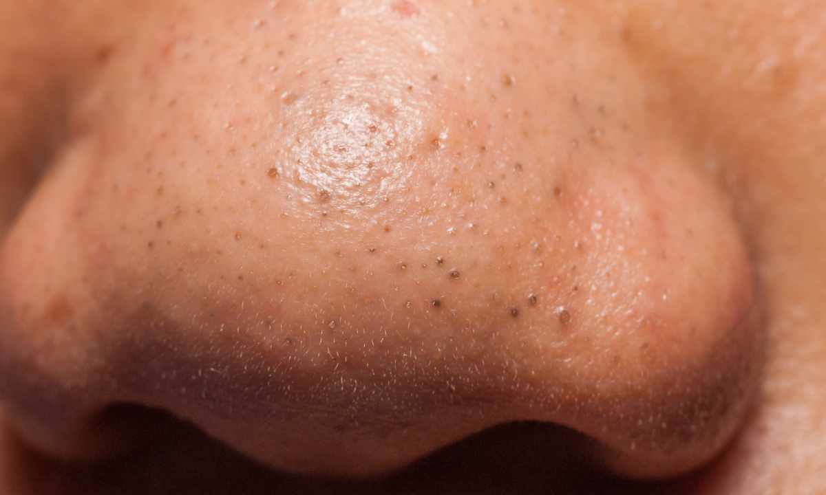 How to get rid of pimples and face blackheads
