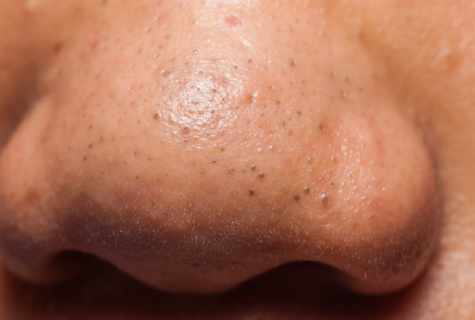 How to get rid of pimples and face blackheads