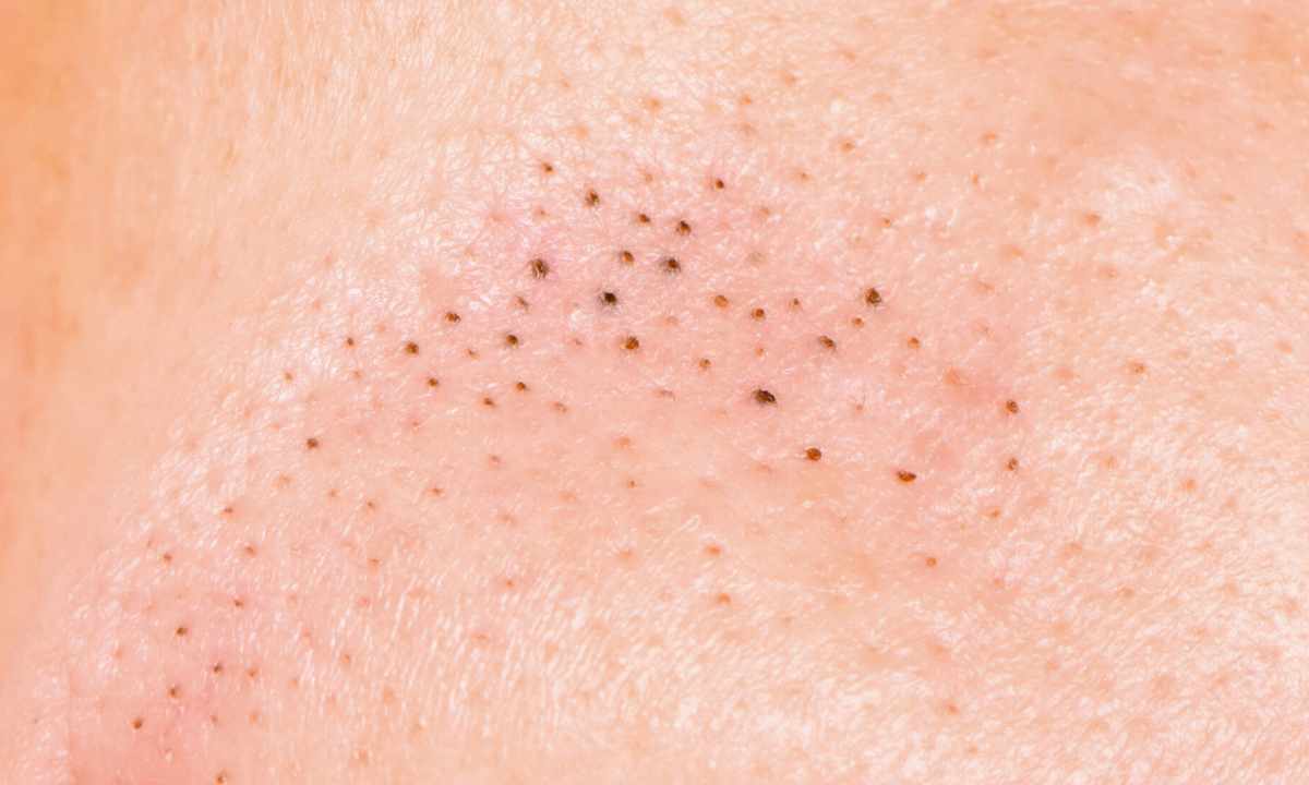 How to get rid of black dots on face skin