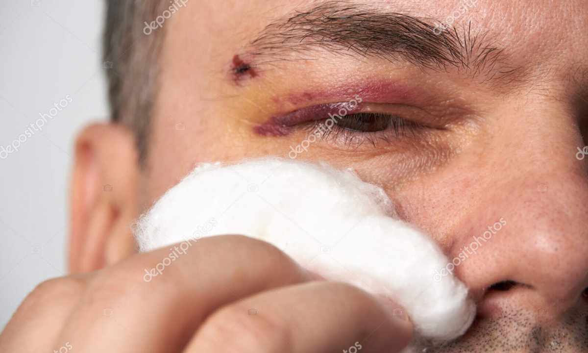 How to reduce bruise from face