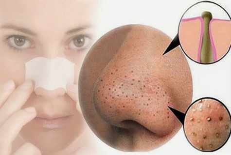 How to get rid of black dots on nose quickly