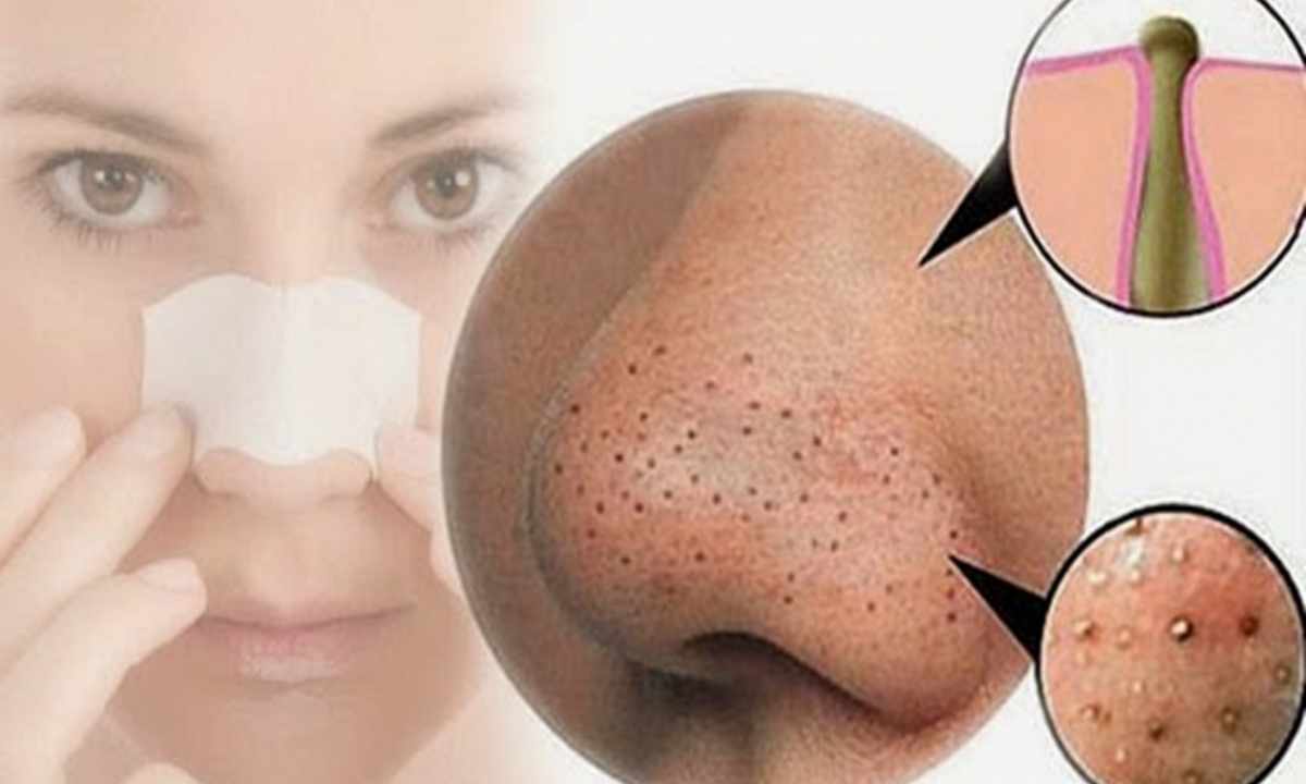 How to get rid of black dots on nose in house conditions