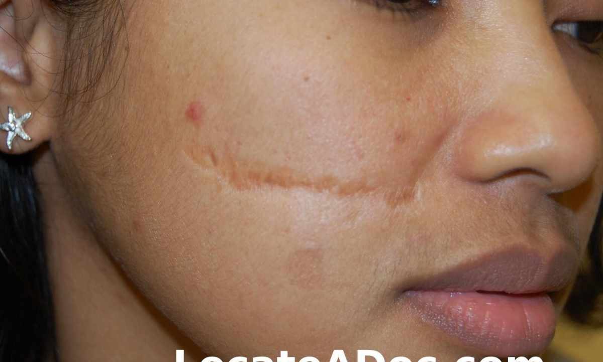 Removal of scars on face