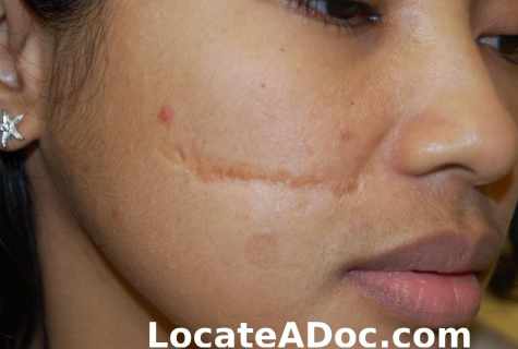 Removal of scars on face
