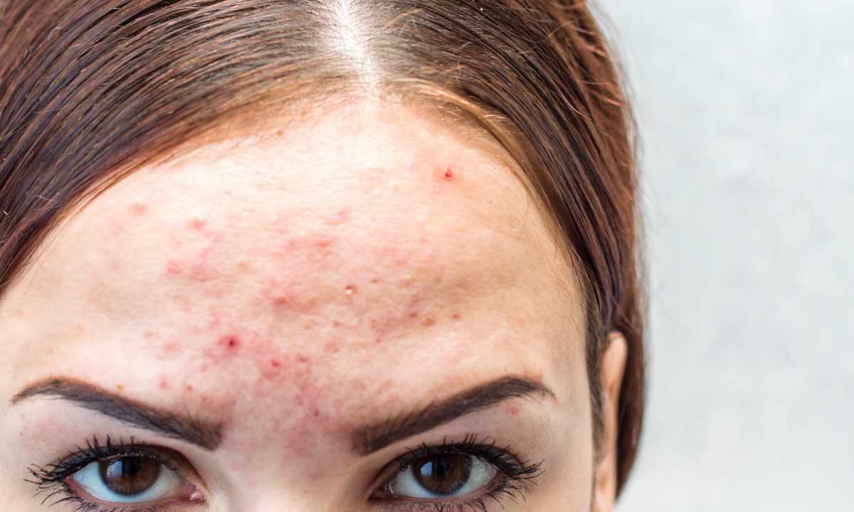 How to get rid of pigmental spots from pimples