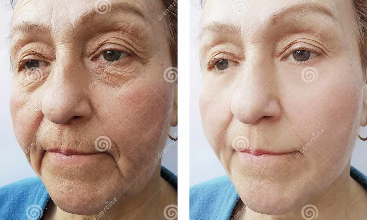 How to remove wrinkles house conditions