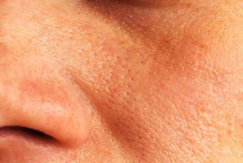 How to get rid of enlarged pores on face
