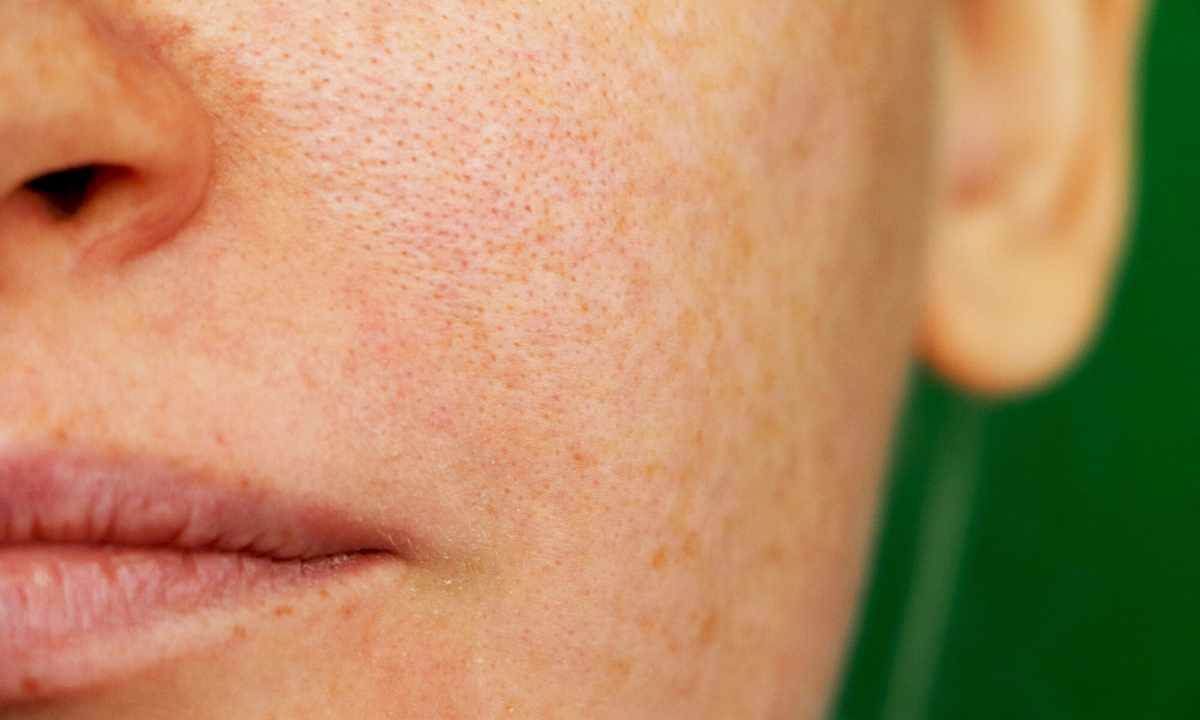 How to get rid of enlarged pores