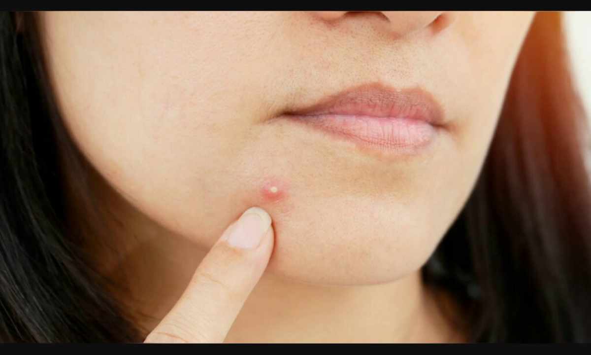 How to prevent pimples