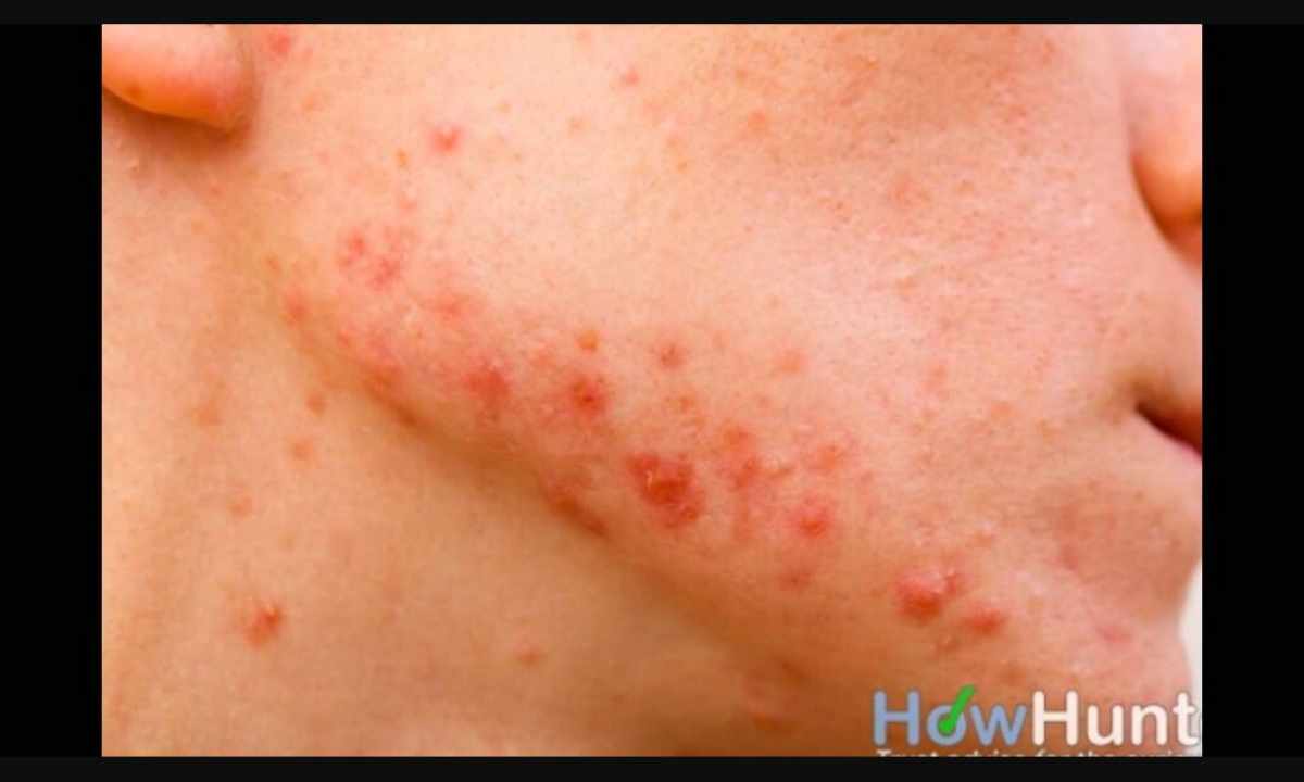 How to get rid of acne rashes on skin