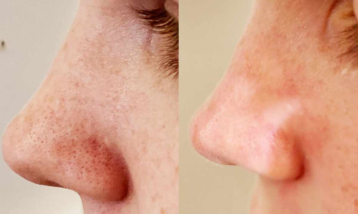 How to get rid of enlarged pores on face? Recipes for narrowing of time