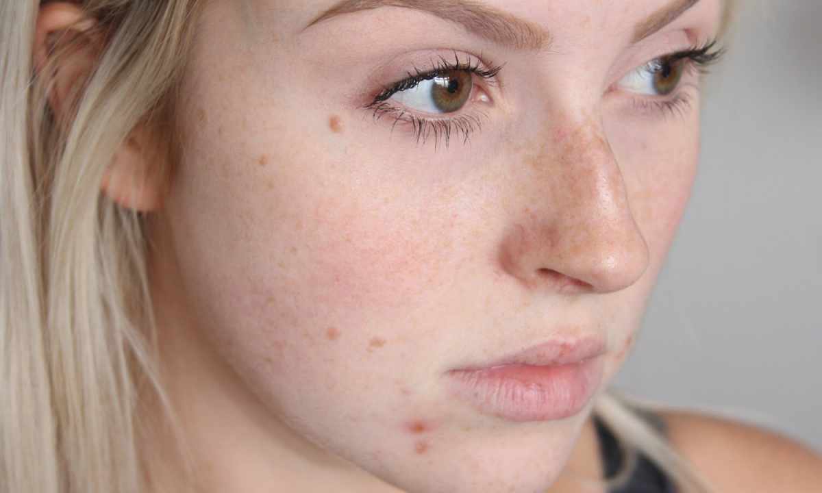 How to hide red spots on face? The equal shining color without problems