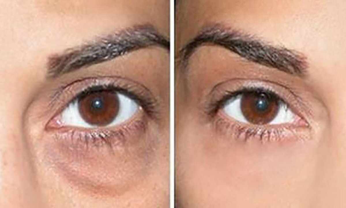 How to remove bags under eyes house conditions