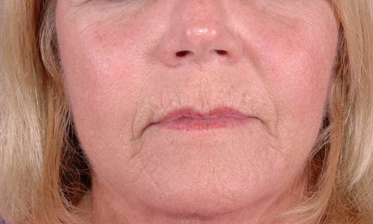How to remove wrinkles on nose bridge