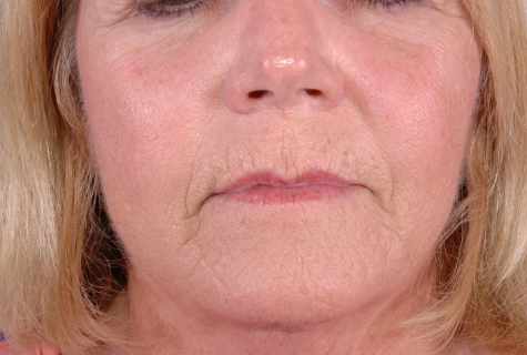 How to remove wrinkles on nose bridge