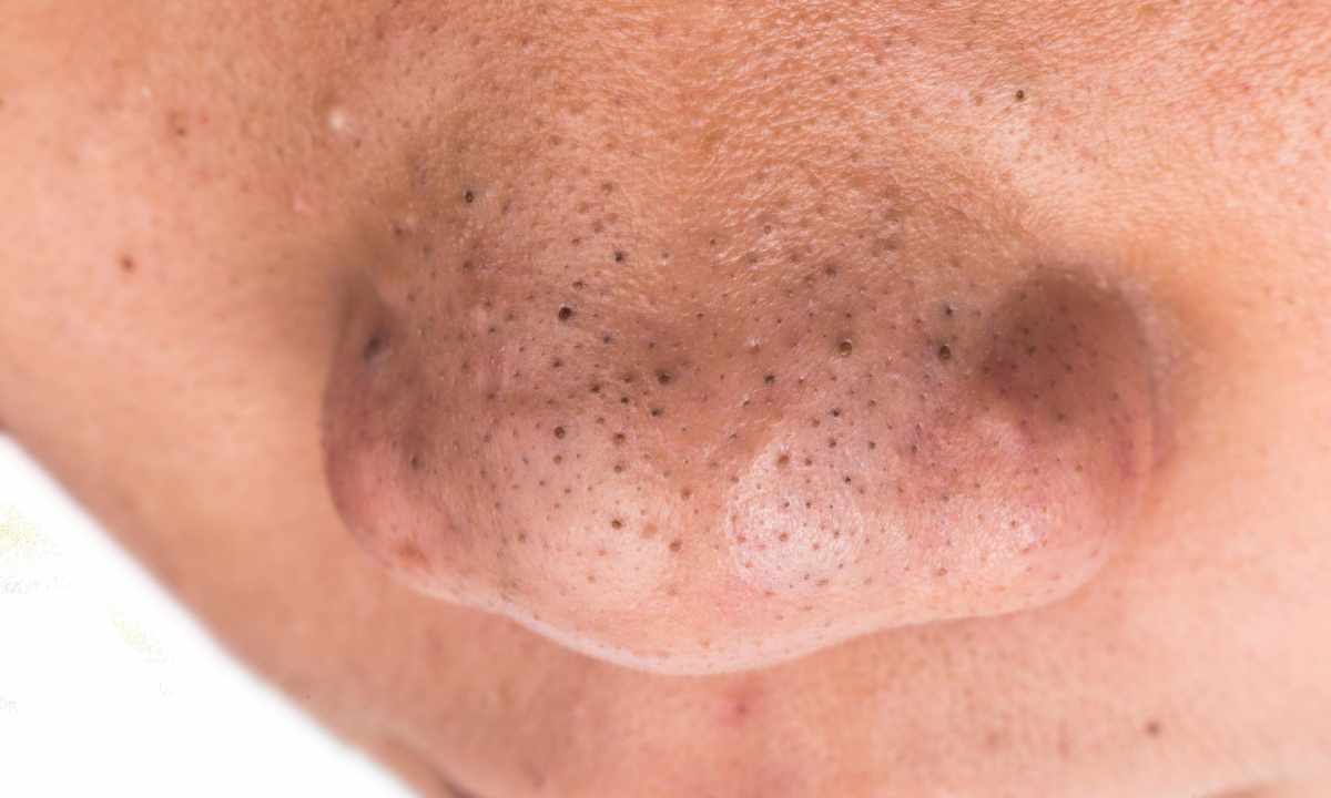 How to get rid of pimples and of black dots