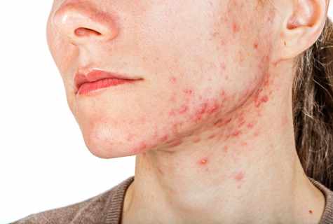 As acnes and diseases of internals are connected among themselves