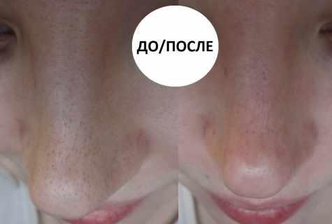 Black dots and enlarged pores: fight methods