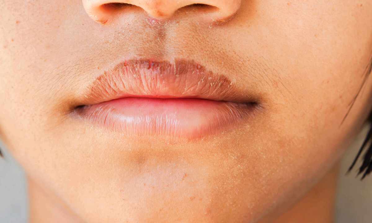 How to treat lips for dryness