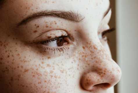 How to get rid of freckles quickly