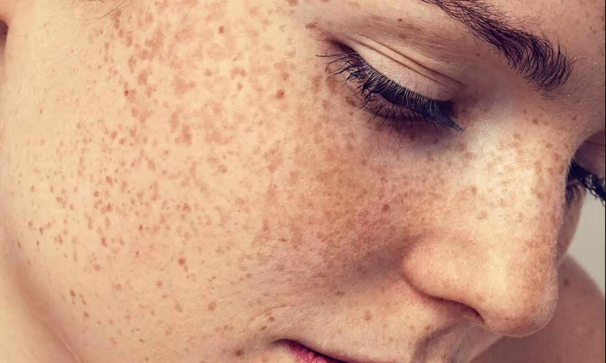 How to remove face freckles