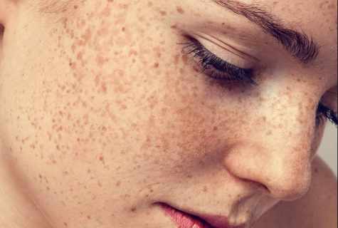 How to remove face freckles