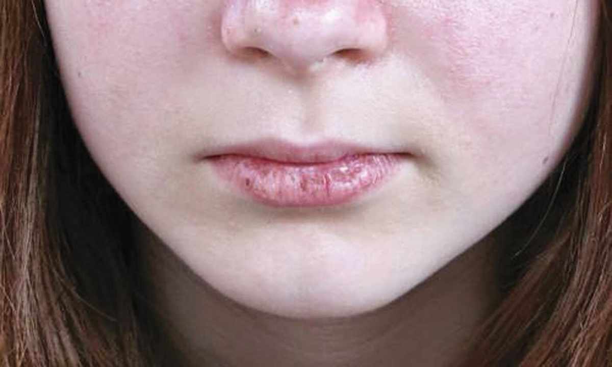 How to get rid of dryness of lips