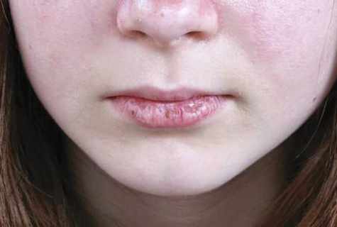 How to get rid of dryness of lips