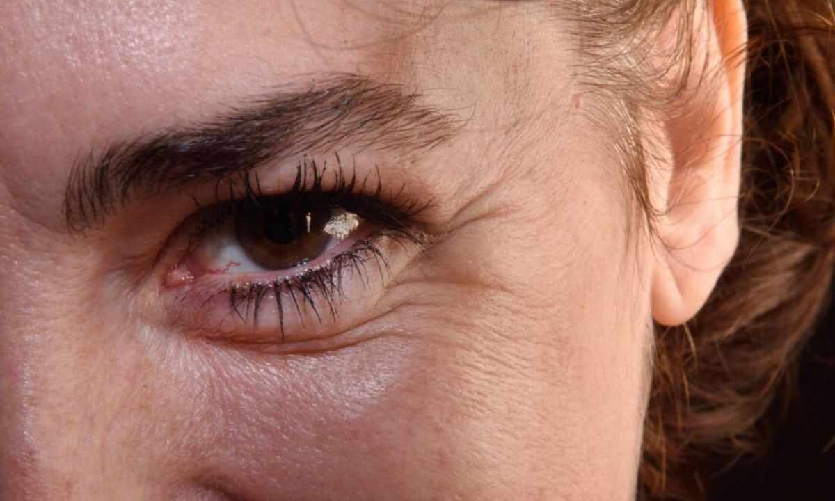 How to remove mimic wrinkles around eyes