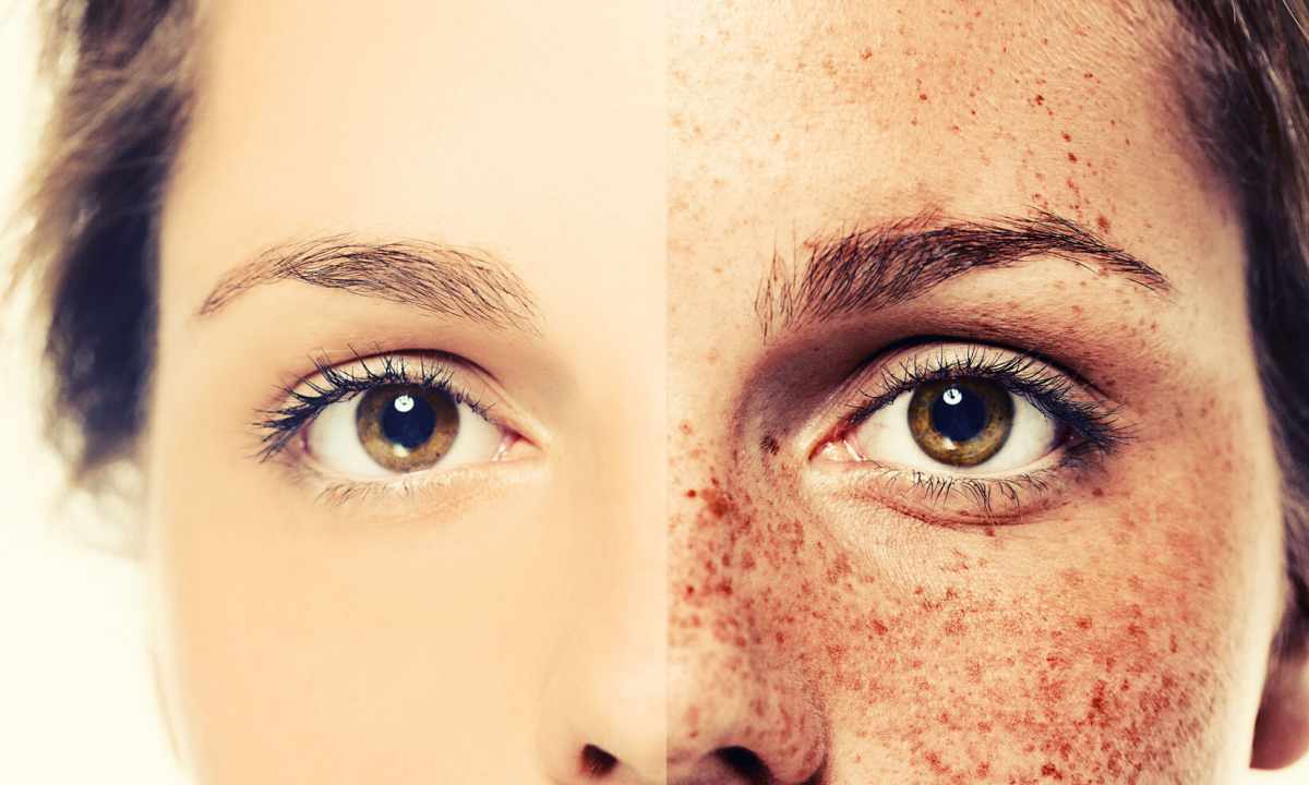 How to get rid of pigmentation and freckles