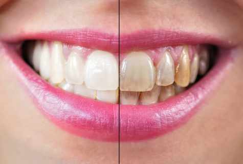 How to bleach teeth in house conditions without harm for enamel