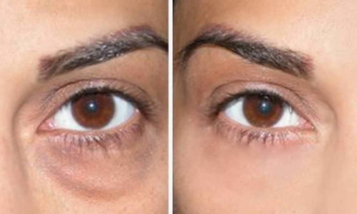 How to remove circles and bags under eyes