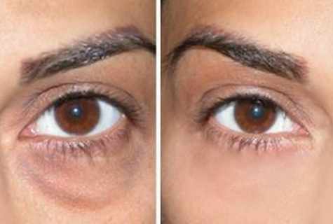 How to remove circles and bags under eyes