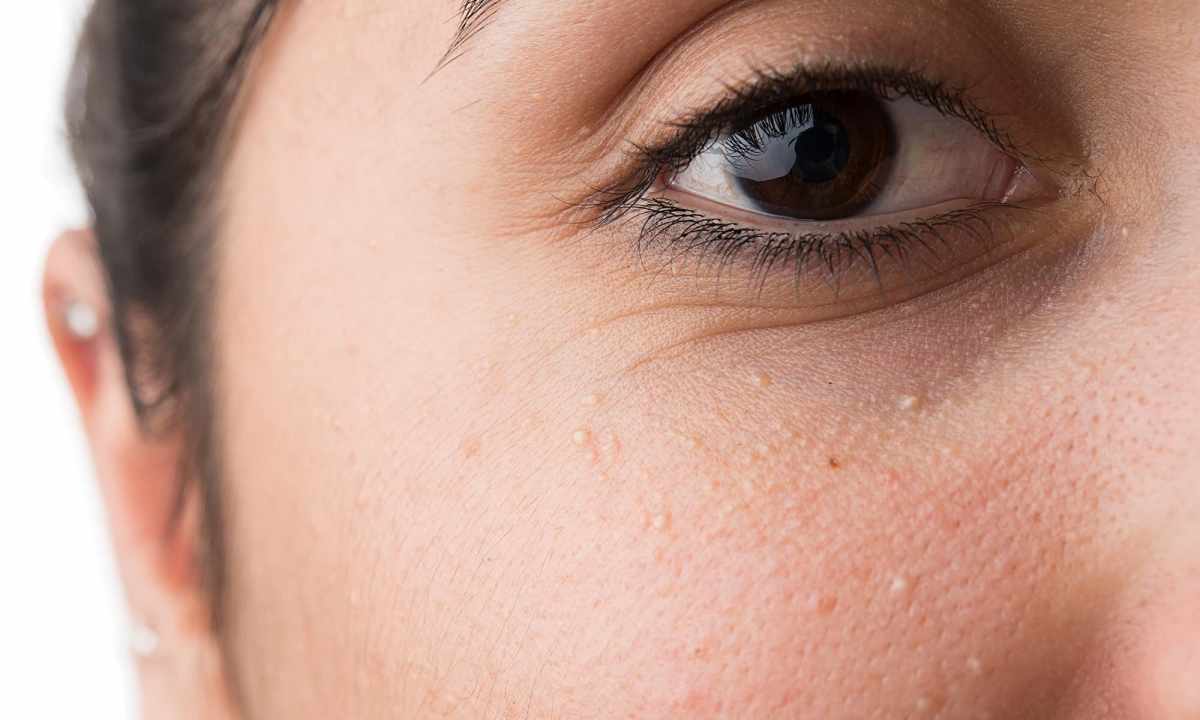 How to get rid of spots under eyes